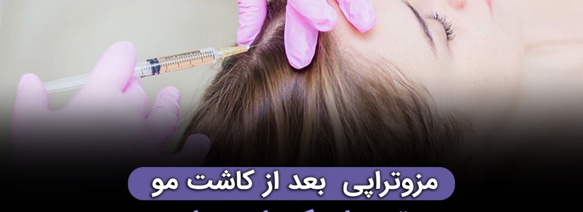 مزوتراپی بعد از کاشت مو